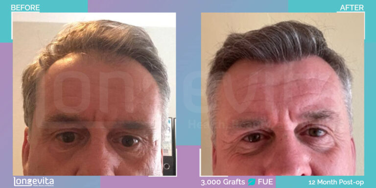 Male FUE 3,000 graft Hair transplant turkey Before After