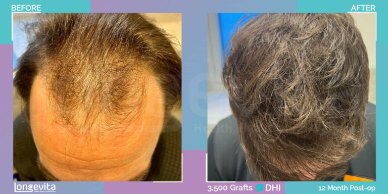 male hair transplant turkey 37 years old dhi 3500 grafts