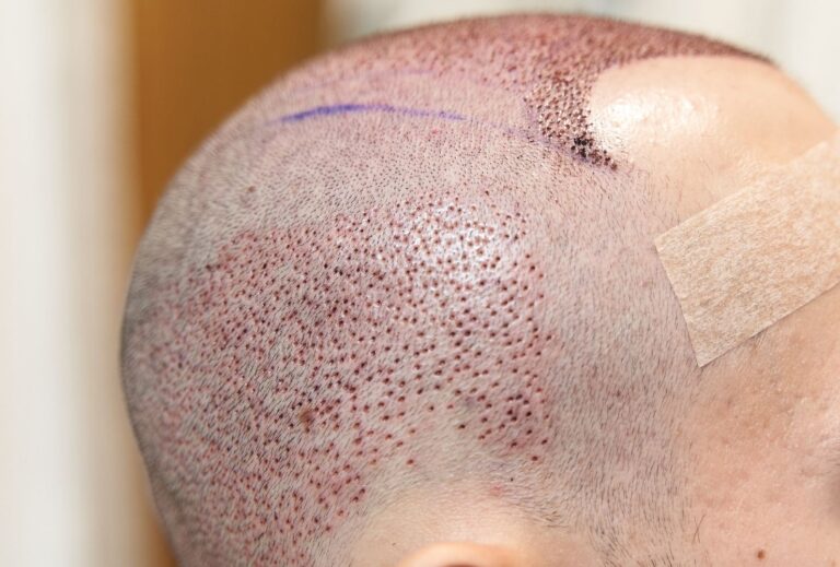 sapphire fue hair transplant turkey