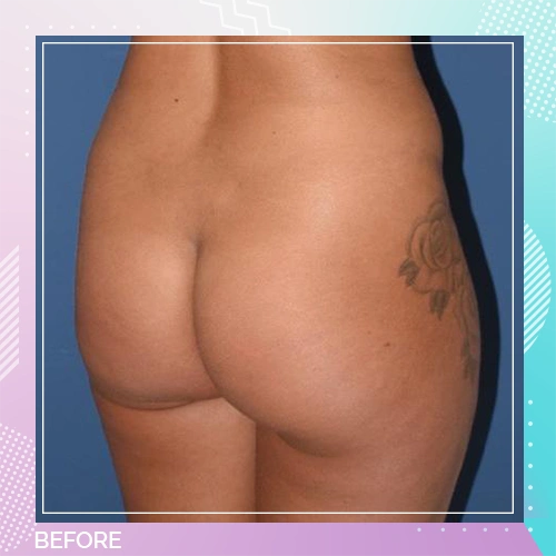 BBL Patient 9 before – Dr Tamer