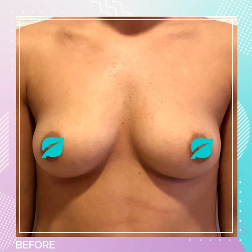 Breast Enlargement Patient 15 before – Dr Tamer