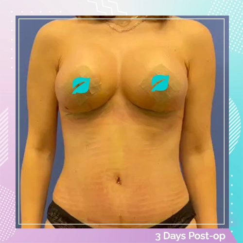 Mommy Makeover Patient 9 after – Dr Tamer