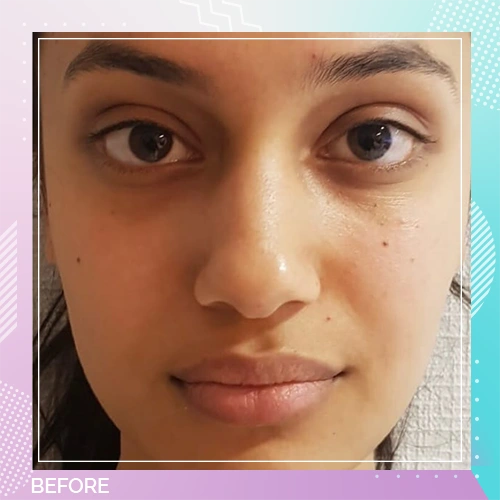 Nose Job Patient 18 before – Dr Tamer