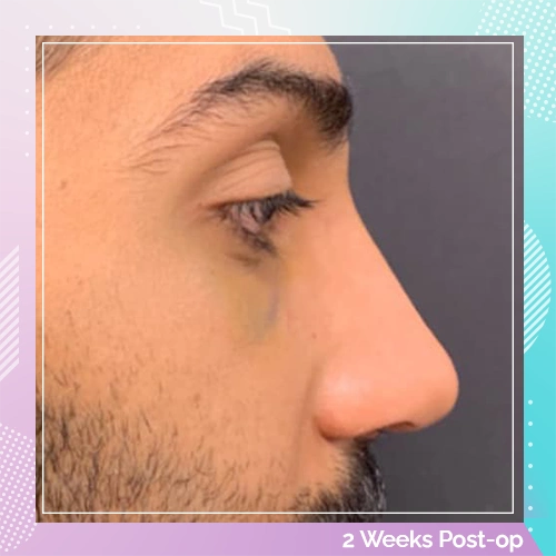 Nose Job Patient 19 after Dr Tamer
