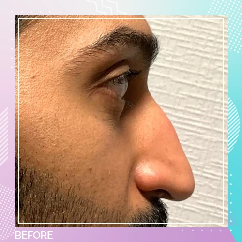 Nose Job Patient 19 before – Dr Tamer