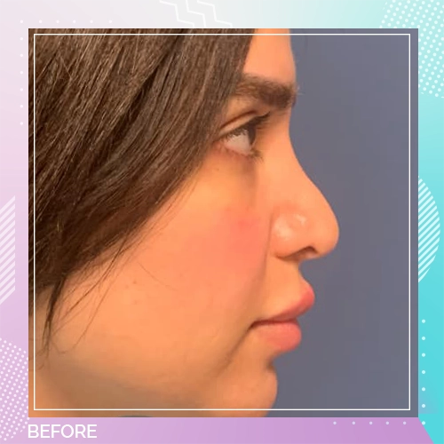 Nose Job Patient 21 before – Dr Tamer