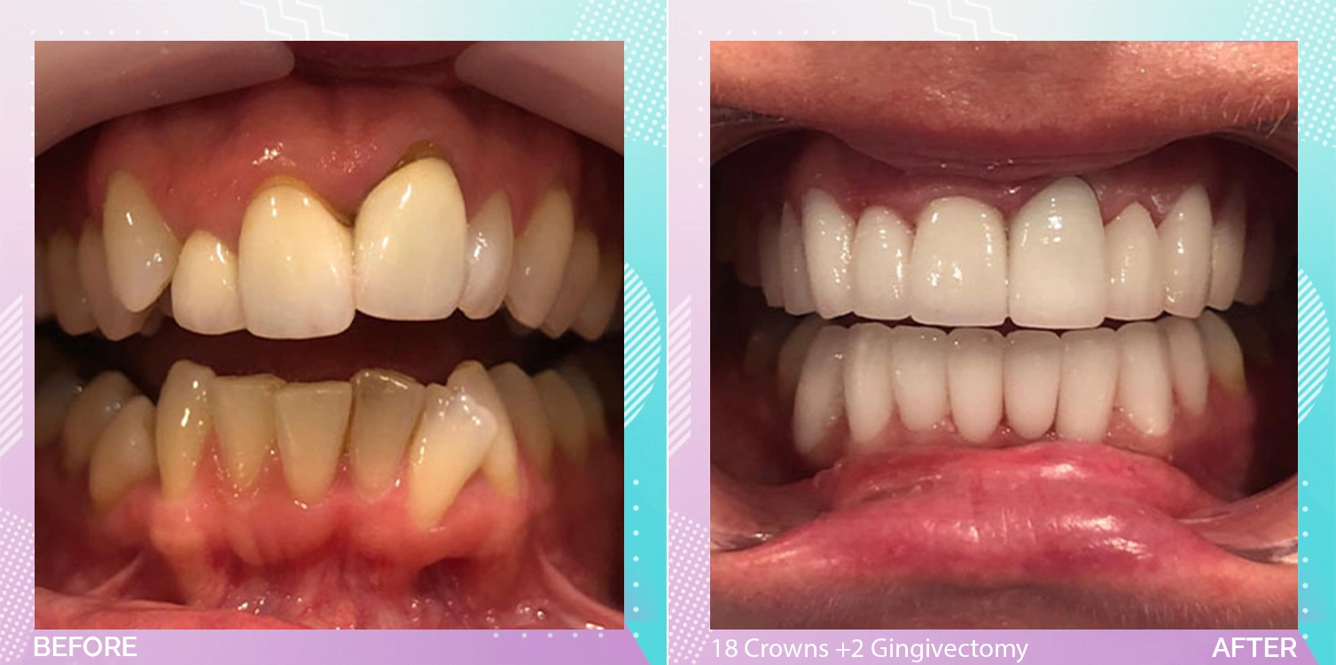 Dental Crowns in Turkey patient 1.webp