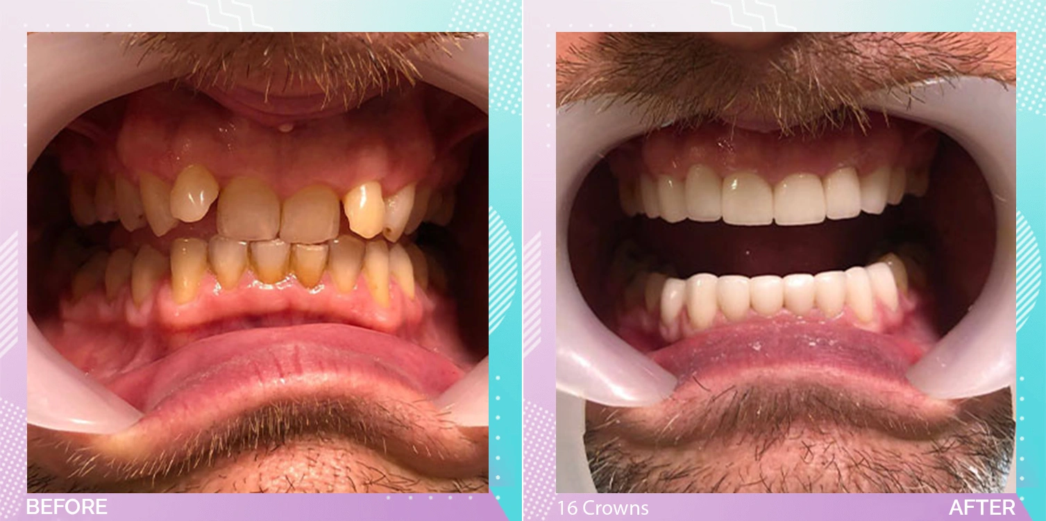 Dental Crowns in Turkey patient 2.webp