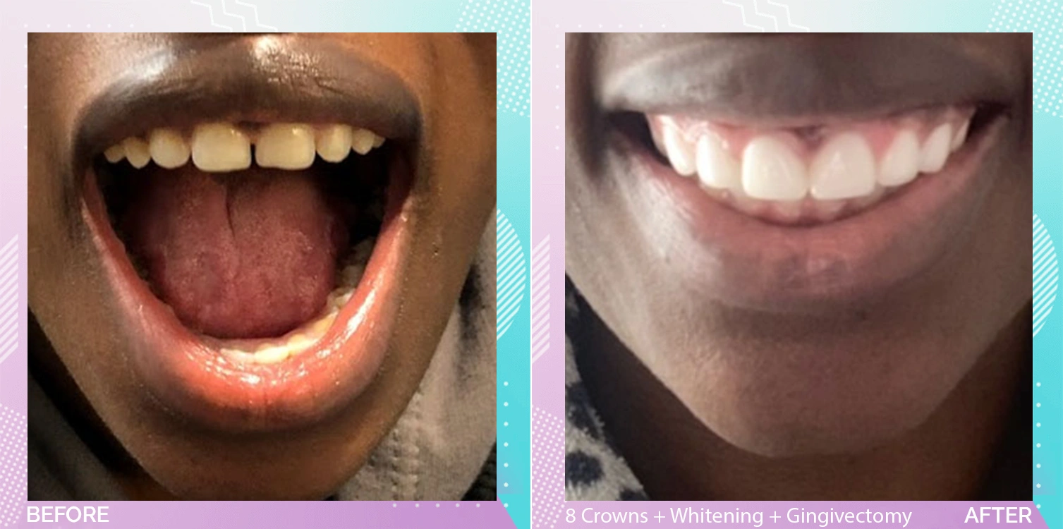 Dental Crowns in Turkey patient 3.webp