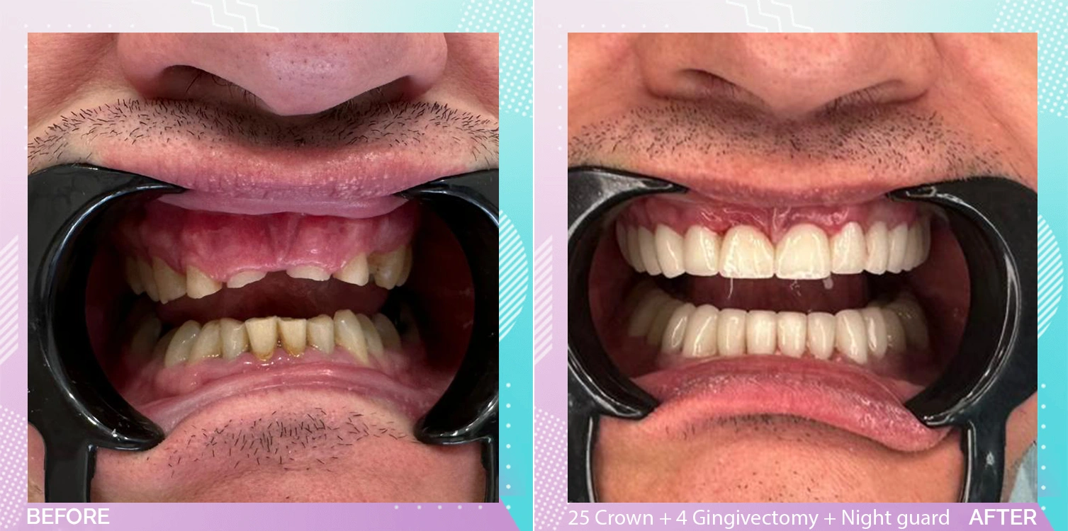 Dental Crowns in Turkey patient 4.webp