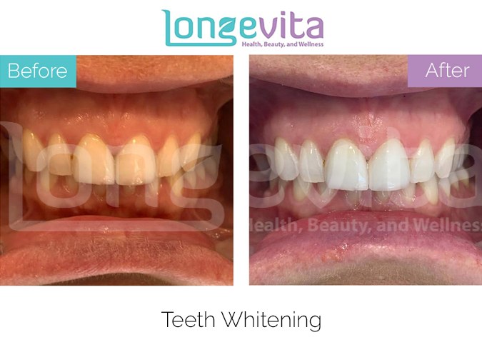 Teeth whitening before after 1.jpg