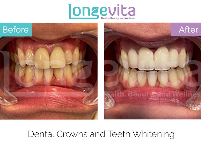 Teeth whitening before after 2.jpg