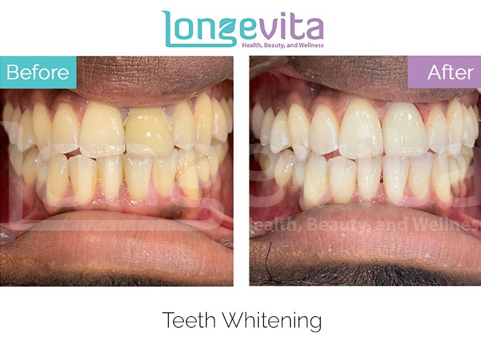 Teeth whitening before after 4.jpg