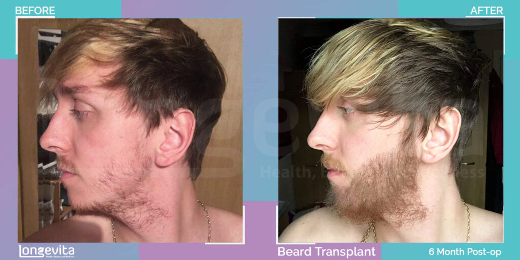 Male Beard Hair Transplant, 3000 grafts 6 months recovery stage before and after images