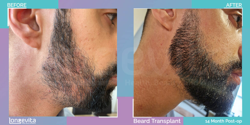 beard transplant 1250 grafts 14 month recovery