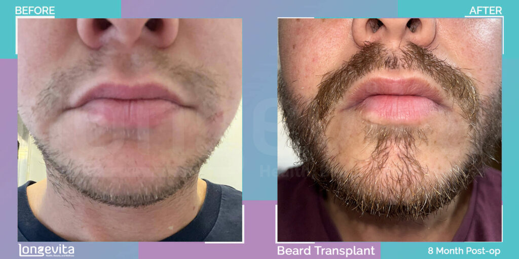 beard hair replacement 8 months recovery stage before and after