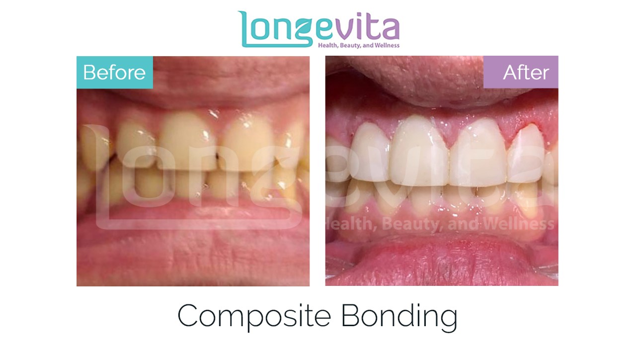 composite bonding before after 7.jpg
