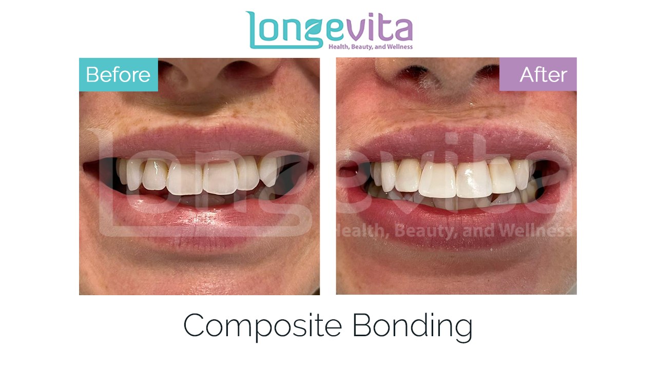 composite bonding before after 8.jpg