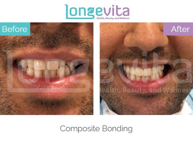 composite bonding turkey before and after 1 670x500 1.jpg
