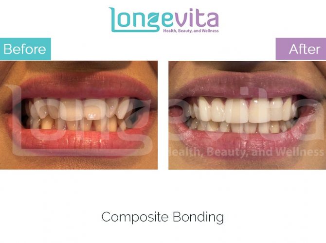 composite bonding turkey before and after 2 670x500 1.jpg