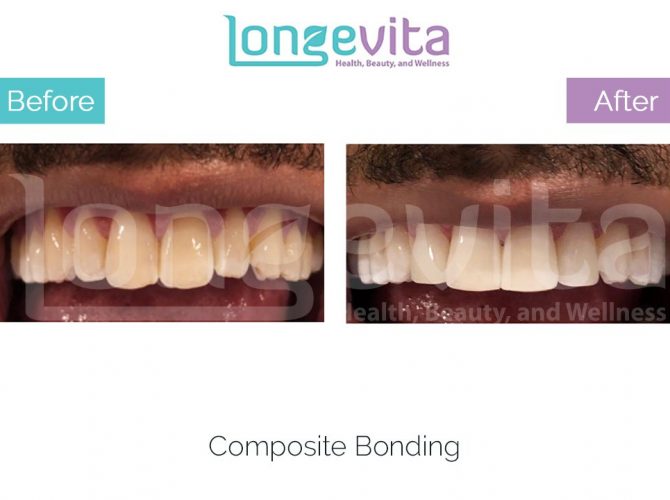 composite bonding turkey before and after 3 670x500 1.jpg