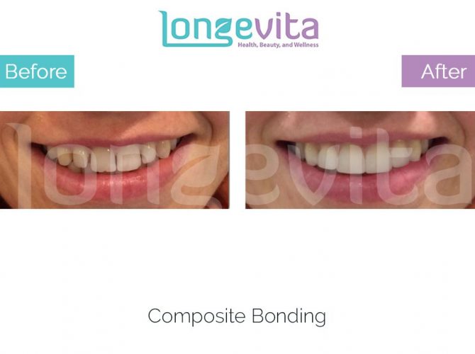 composite bonding turkey before and after 4 670x500 1.jpg
