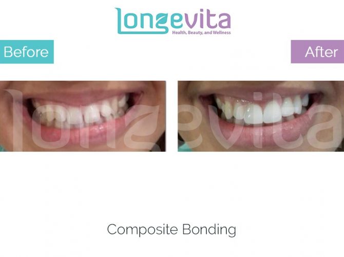 composite bonding turkey before and after 5 670x500 1.jpg