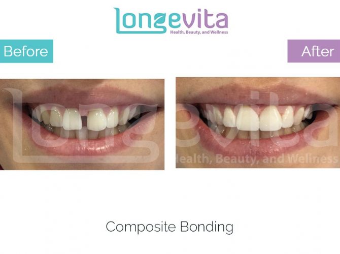 composite bonding turkey before and after 6 670x500 1.jpg