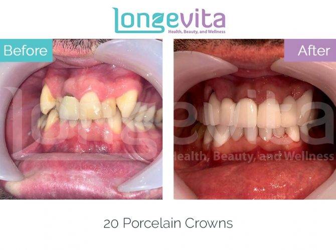 dental crowns turkey before and after 1 670x500 1.jpg