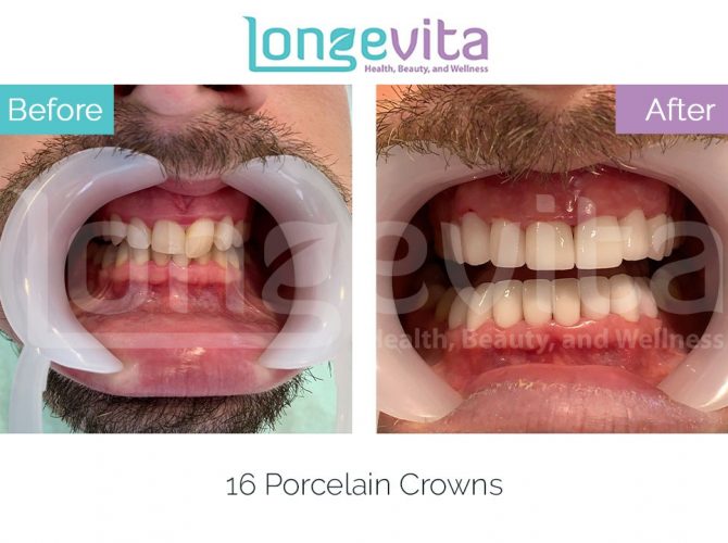 dental crowns turkey before and after 11 670x500 1.jpg