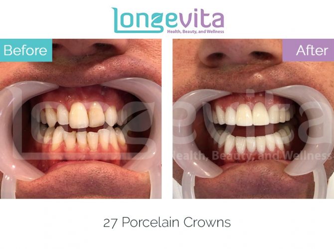 dental crowns turkey before and after 12 670x500 1.jpg