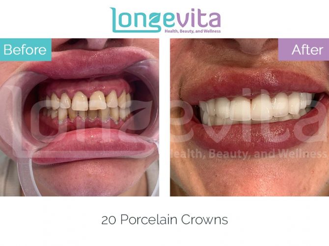 dental crowns turkey before and after 13 670x500 1.jpg