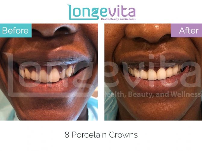 dental crowns turkey before and after 15 670x500 1.jpg