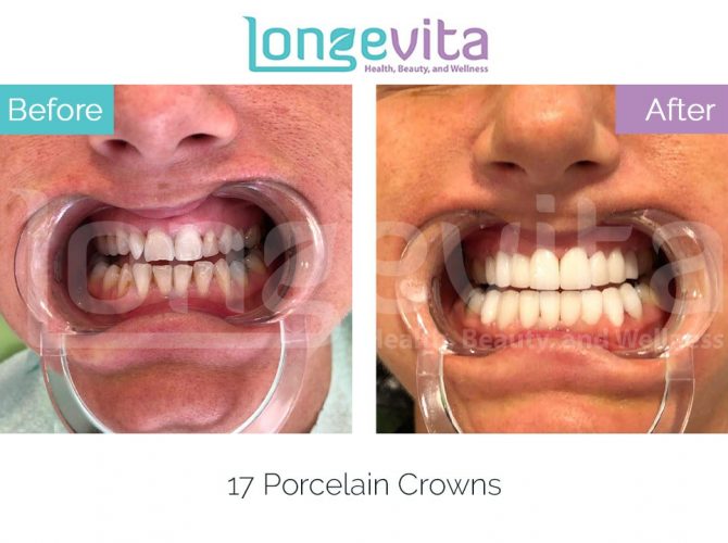 dental crowns turkey before and after 17 670x500 1.jpg