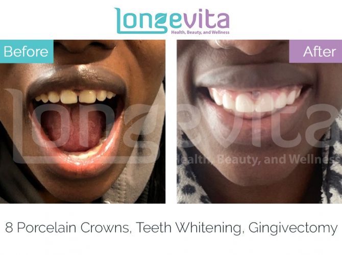 dental crowns turkey before and after 18 670x500 1.jpg