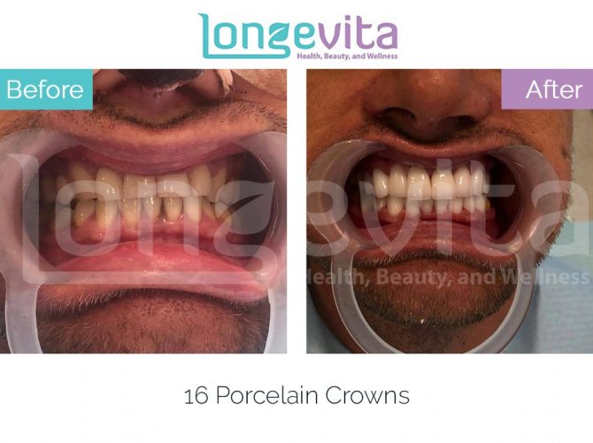 dental crowns turkey before and after 19 670x500 1.jpg