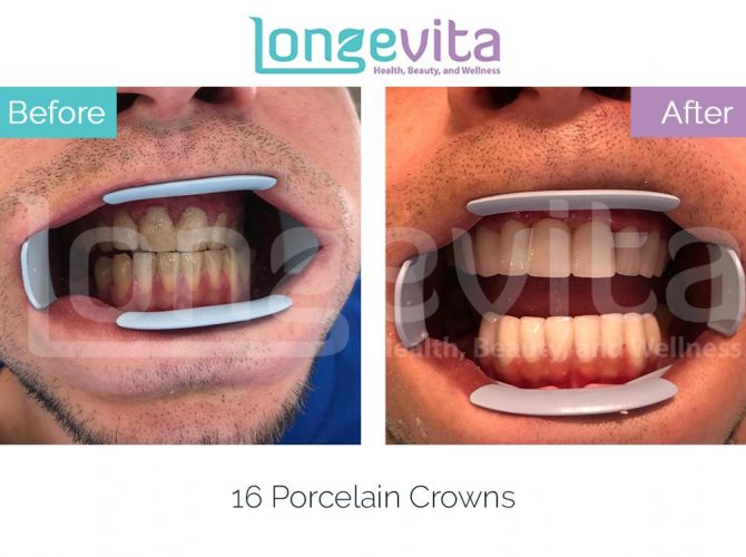 dental crowns turkey before and after 2 1 670x500 1.jpg