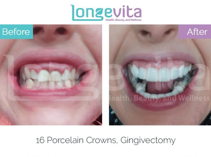 dental crowns turkey before and after 20 670x500 1.jpg