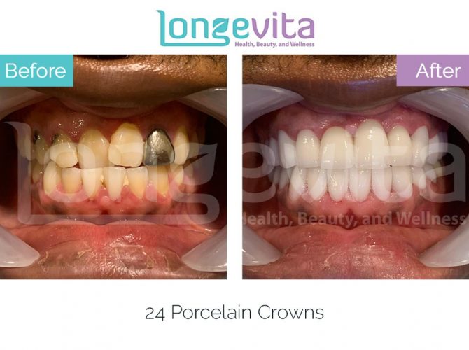 dental crowns turkey before and after 21 670x500 1.jpg