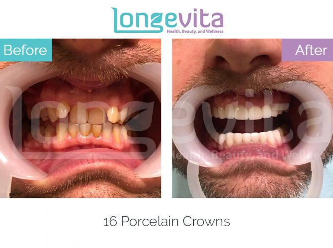 dental crowns turkey before and after 22 670x500 1.jpg