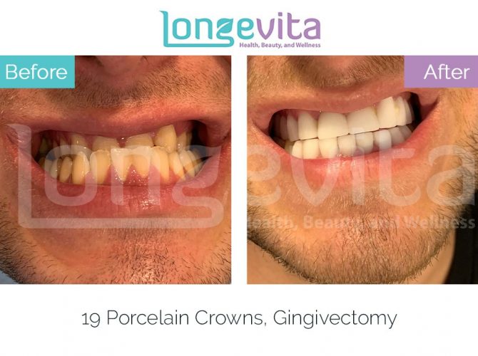 dental crowns turkey before and after 23 670x500 1.jpg