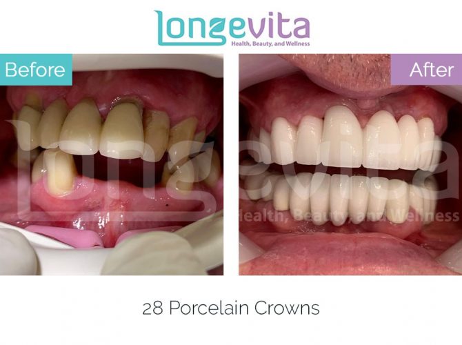 dental crowns turkey before and after 24 670x500 1.jpg