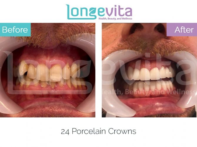 dental crowns turkey before and after 25 670x500 1.jpg