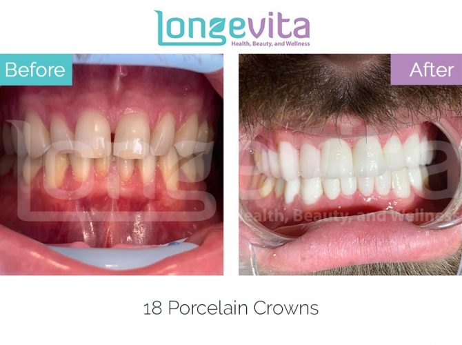 dental crowns turkey before and after 3 670x500 1.jpg