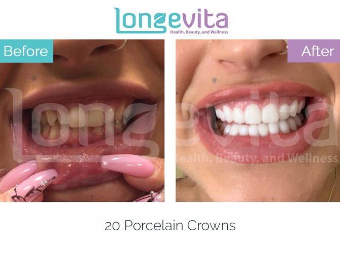 dental crowns turkey before and after 4 670x500 1.jpg