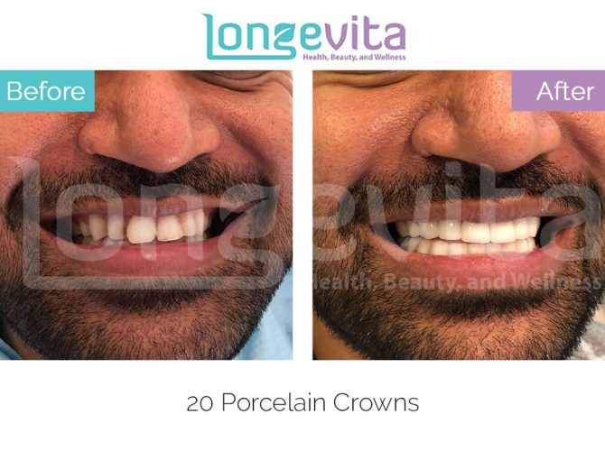 dental crowns turkey before and after 5 670x500 1.jpg