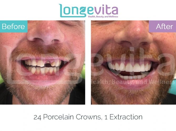 dental crowns turkey before and after 6 670x500 1.jpg