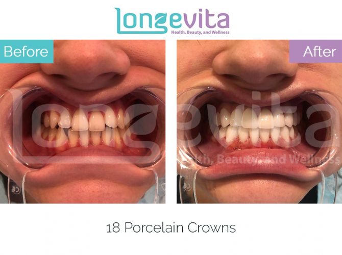dental crowns turkey before and after 7 670x500 1.jpg