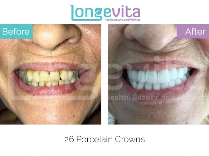 dental crowns turkey before and after 8 670x500 1.jpg