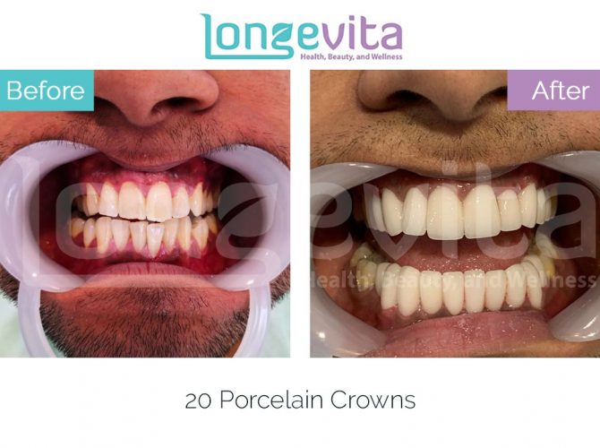 dental crowns turkey before and after 9 670x500 1.jpg